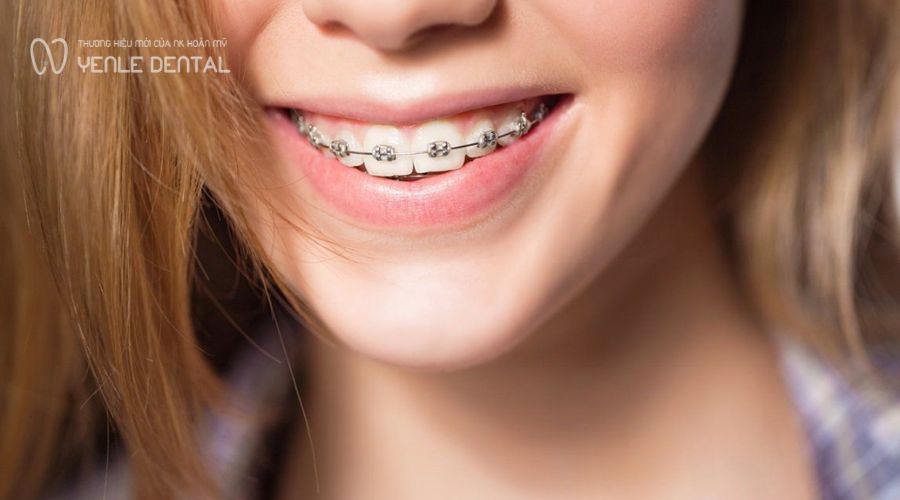Phòng ngừa tụt lợi khi niềng răng